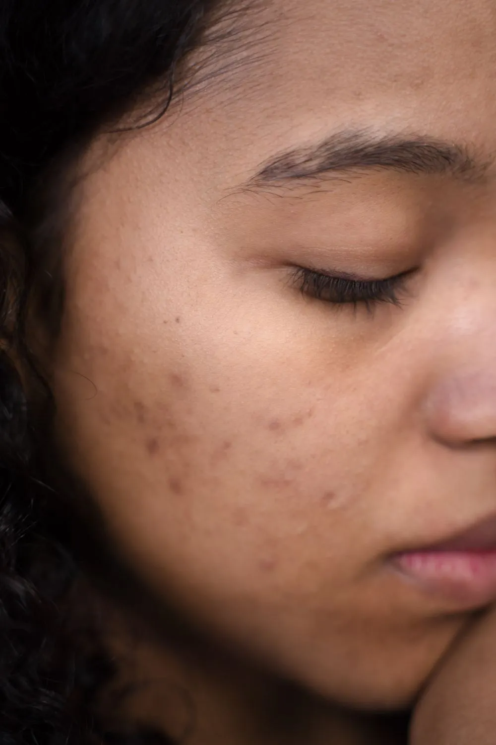 Acne scars