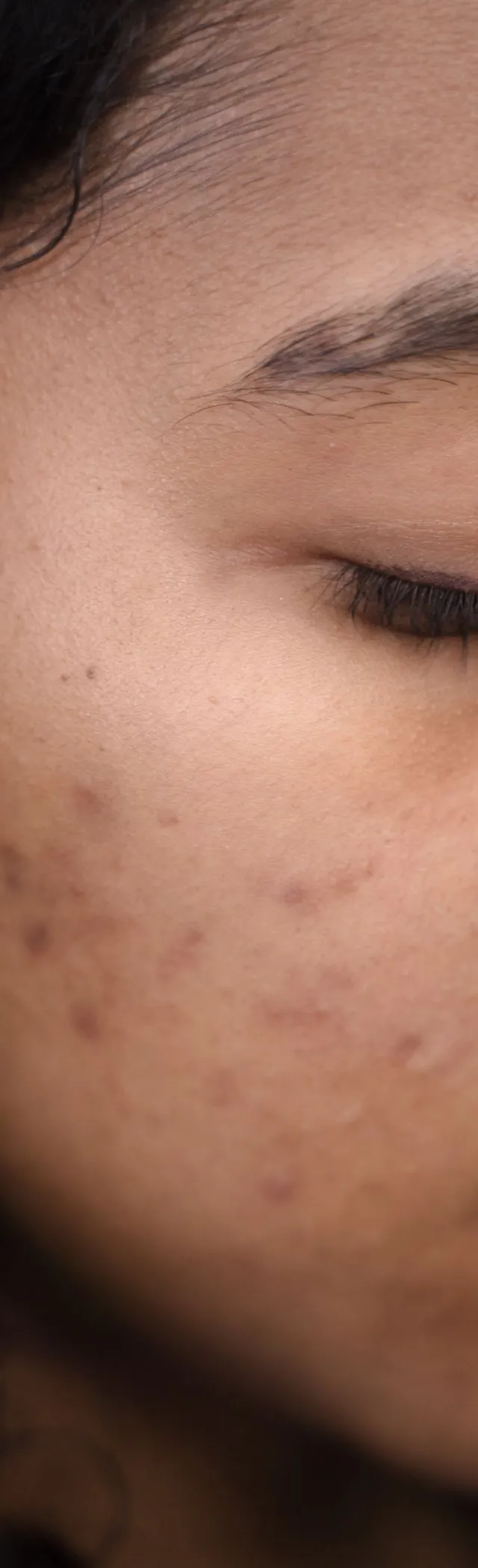 Can acne scars be improved