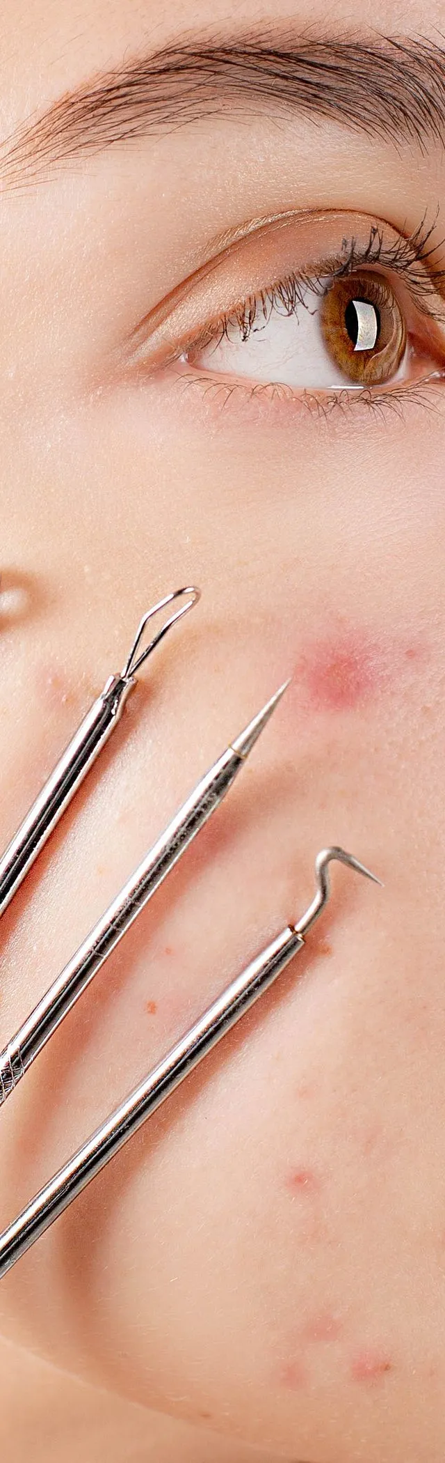 Skincare mistakes that make acne worse