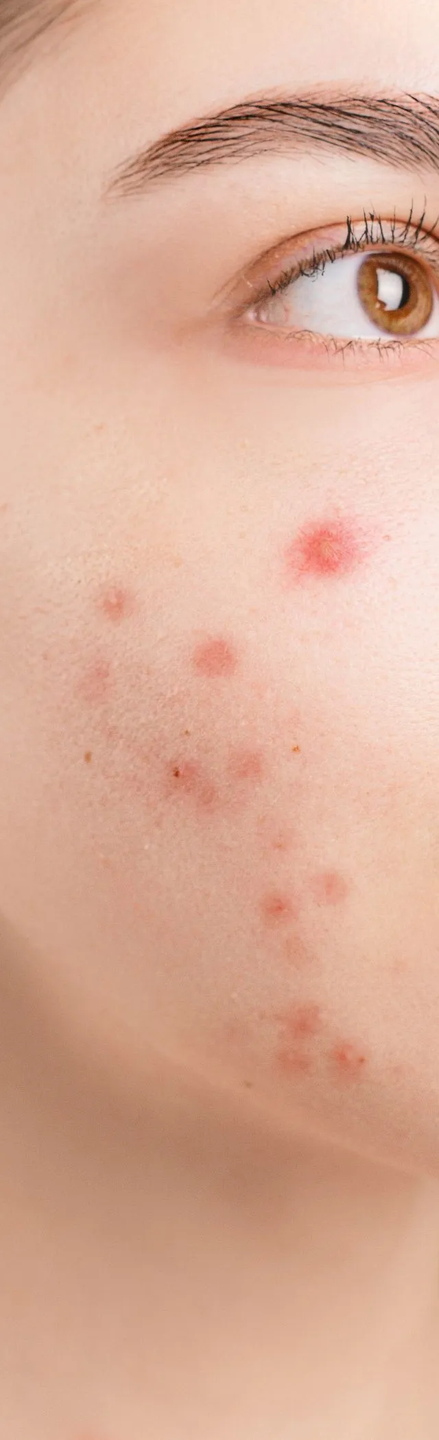 Why does acne keep coming back