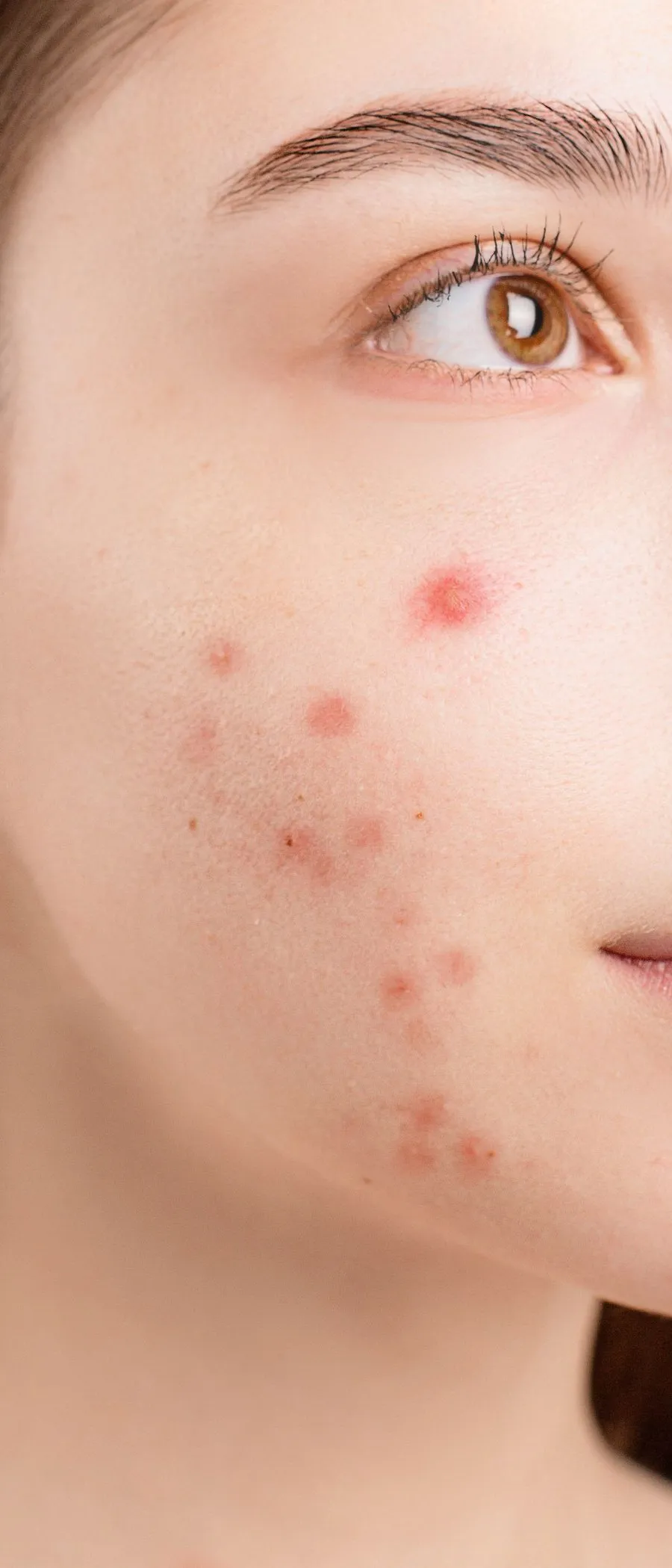 Why does acne keep coming back