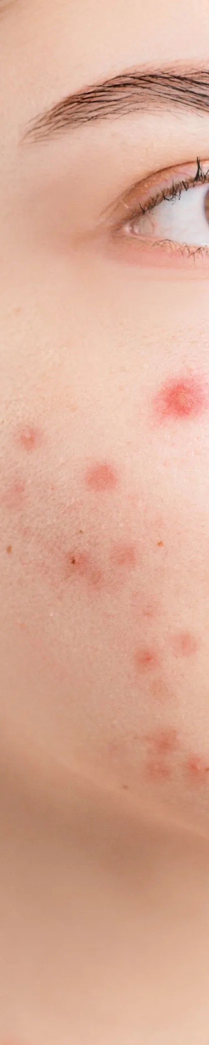 Why does acne keep coming back